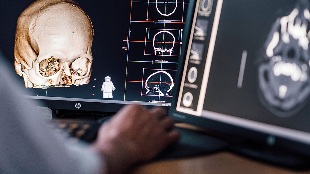 brain bleed analysis using AI