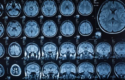 brain scan images