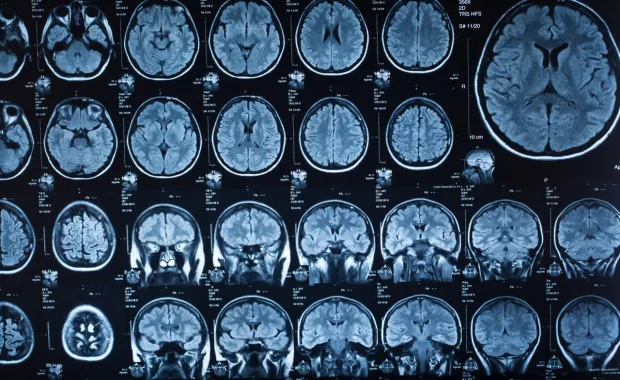 HUS CleverHealth Network brain scans